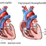 athletes-heart-pathophysiology