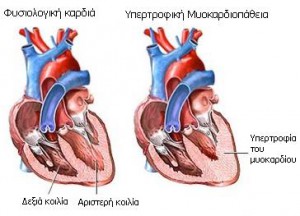 athletes-heart-pathophysiology