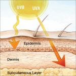 UV rays and Cancer june